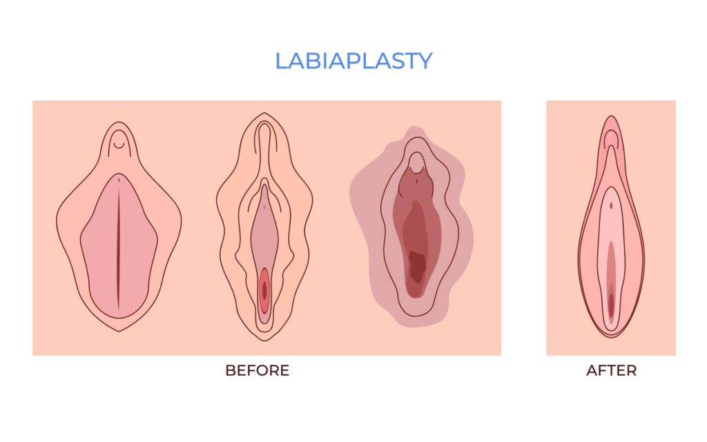 Labiaplasty