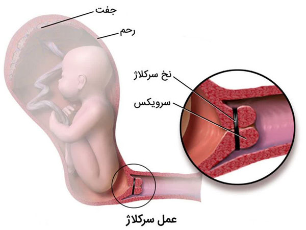 سرکلاژ دهانه رحم