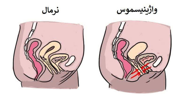 واژینیسم