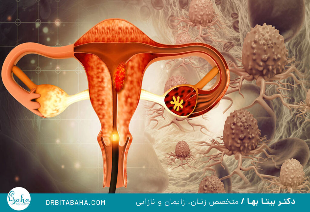 پیشگیری سرطان های زنان