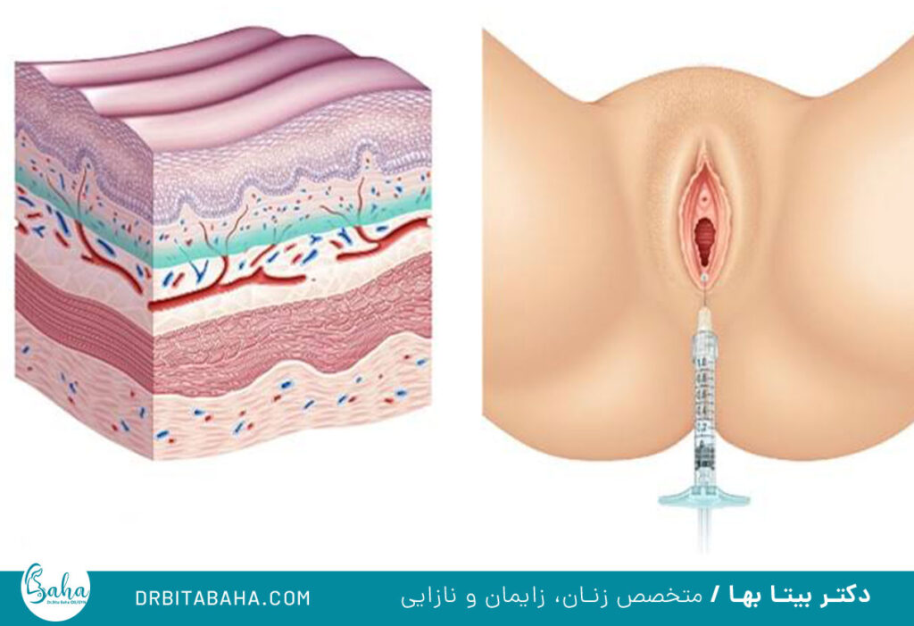 جوانسازی واژن با چربی