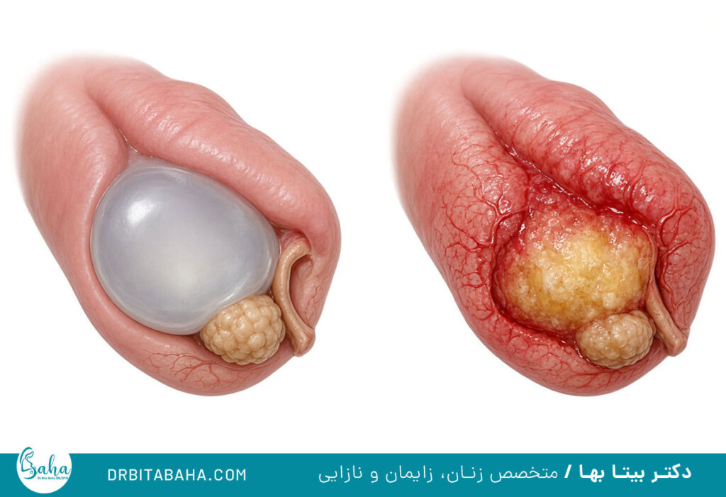 تخلیه کیست بارتولن