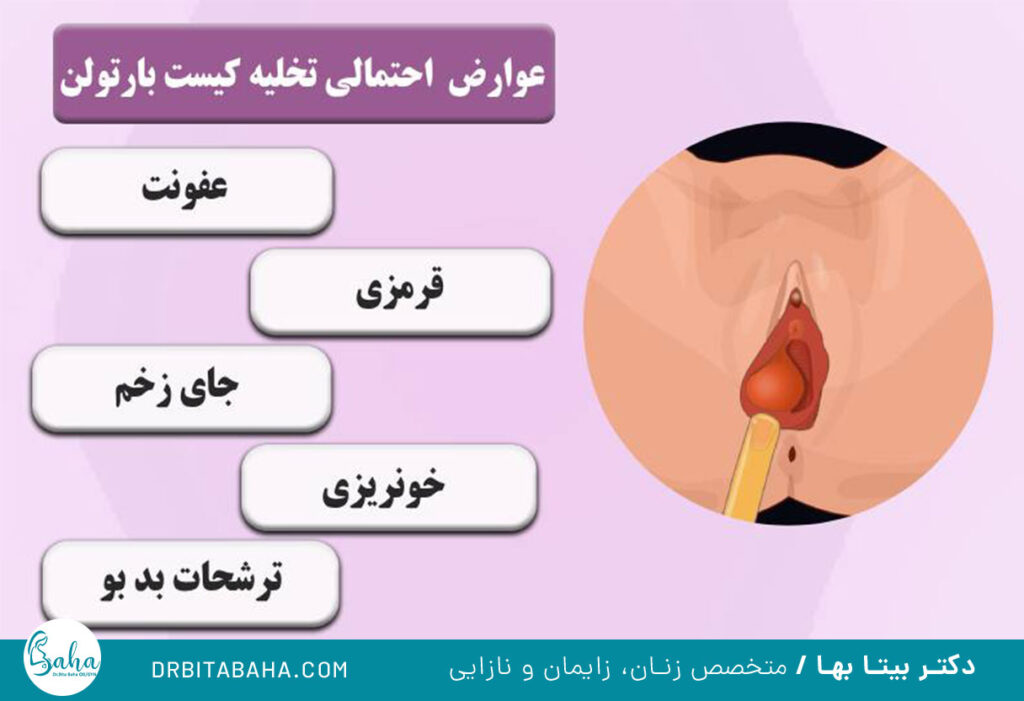 آبسه بارتولن