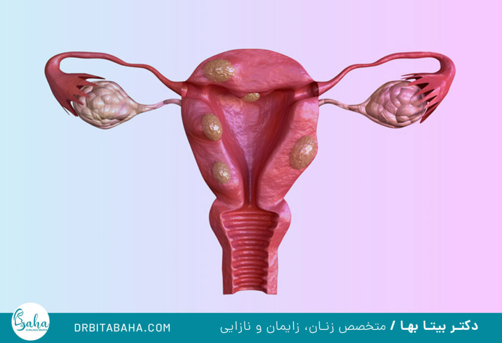 علائم فیبروم رحم