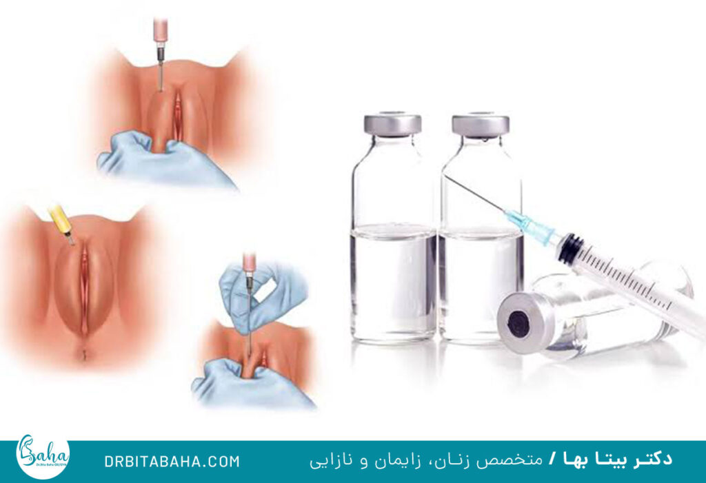 بوتاکس برای واژینیسموس