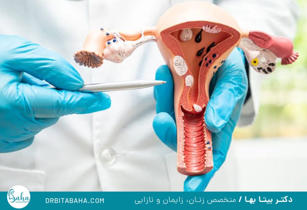 انواع میوم رحمی