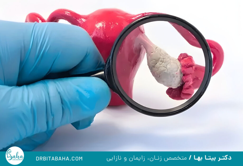 علت به وجود آمدن کیست تخمدان